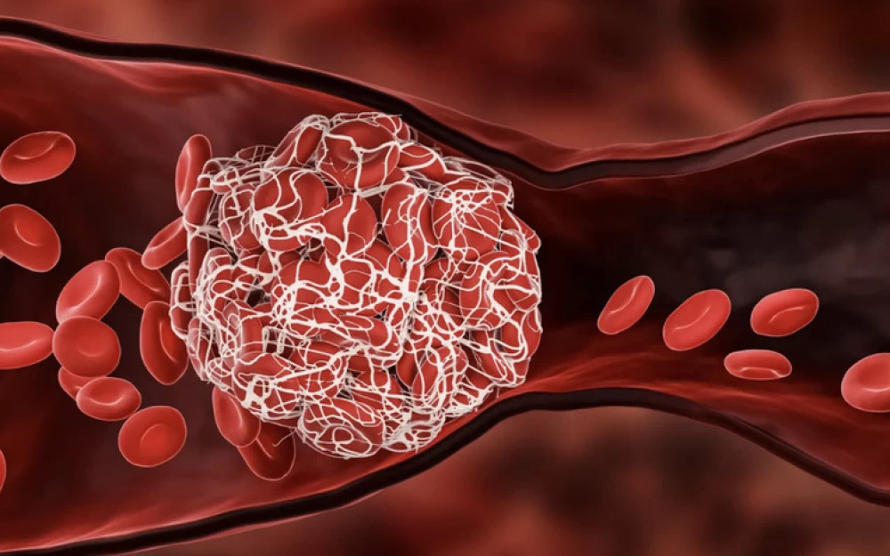 Врач рассказал о коварстве и опасностях отрыва «тромба»