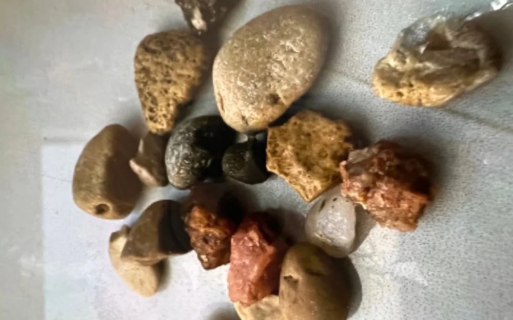 Трехлетний мальчик проглотил более 25 камней в Ессентуках