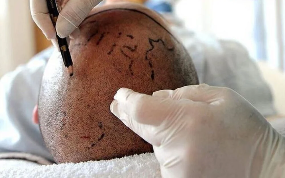 Мужчина умер после пересадки волос и лечения зубов